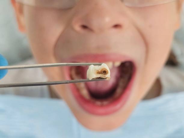 Best Broken or Cracked Tooth Emergency Dentist in Chattanoo Valley, GA
